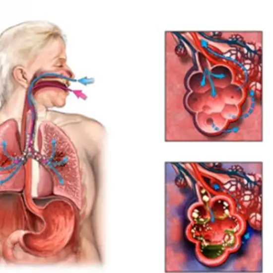 Bronchial Aspiration Fluid
